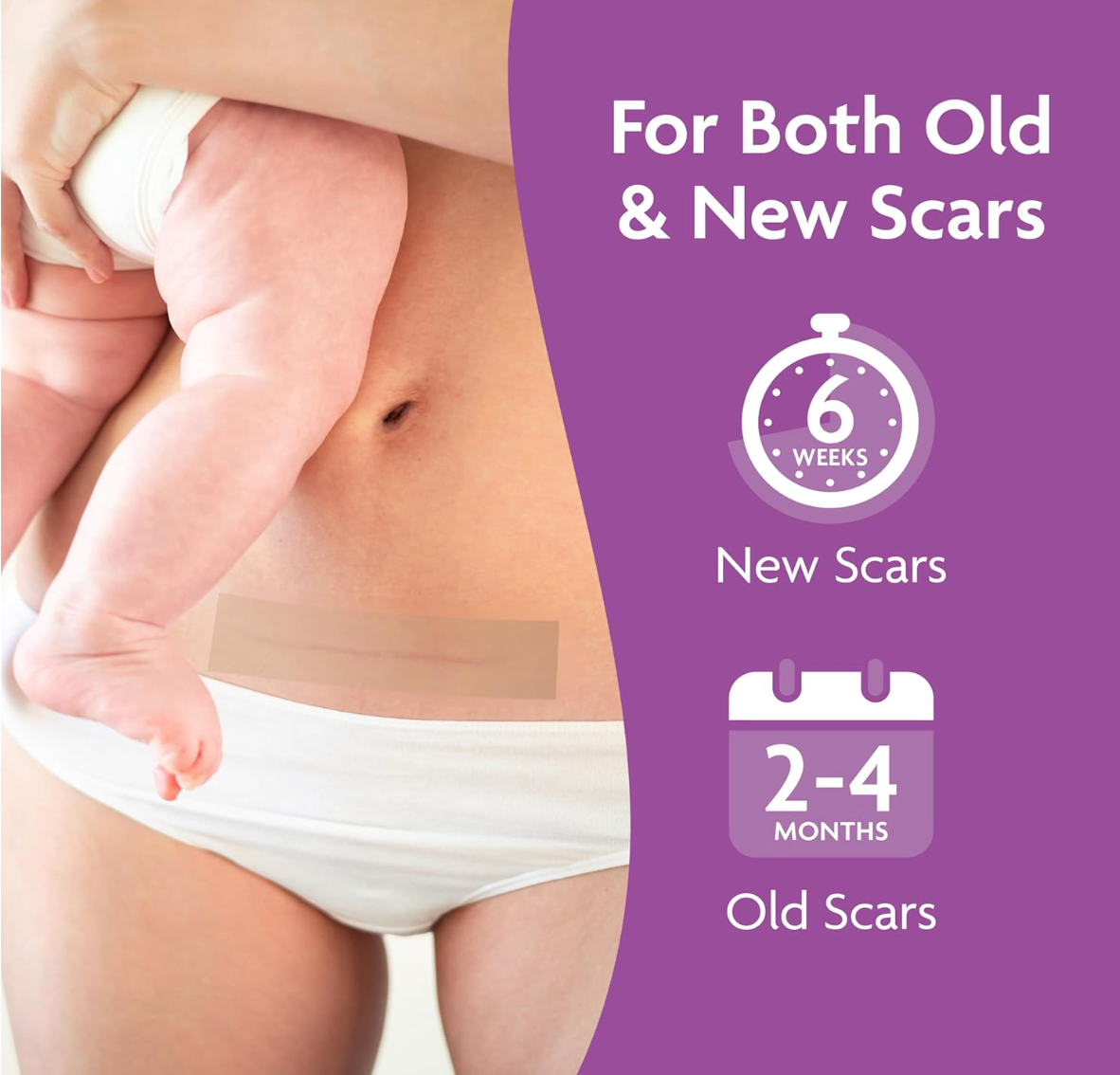 Trilastin Silicone Scar Sheets