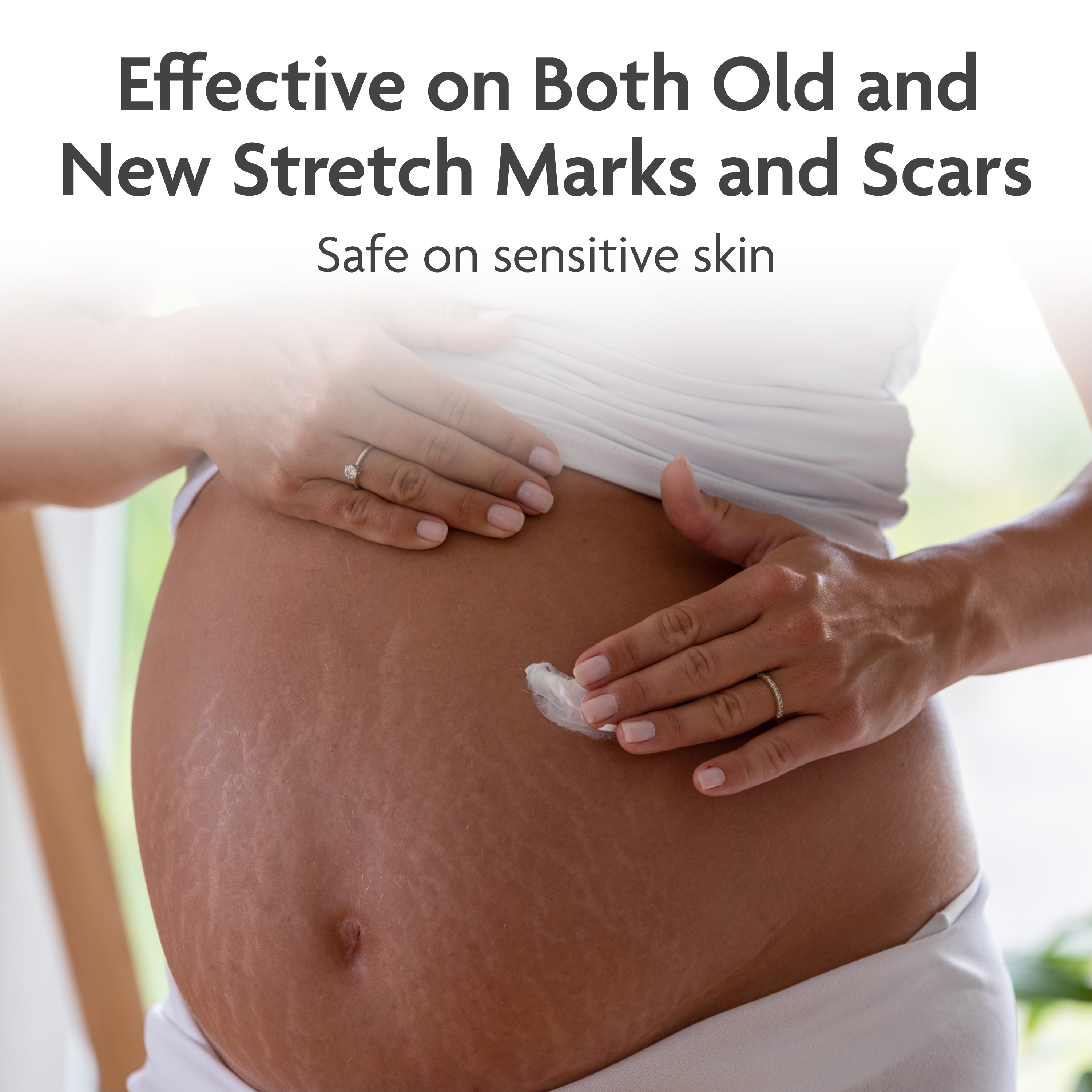 TriLASTIN Stretch Mark Treatment Routine