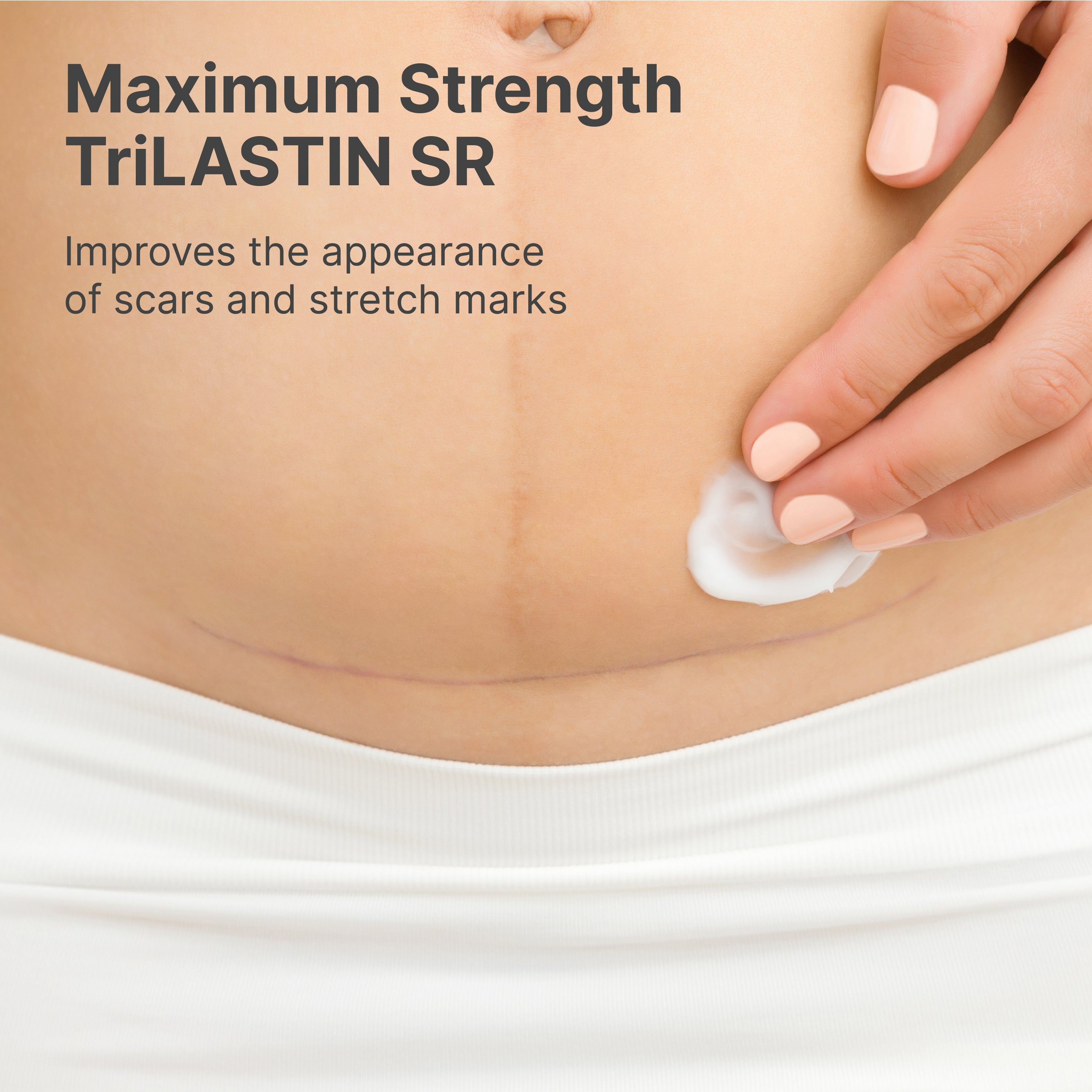 Trilastin Intensive Stretch Mark Cream 3 Month Supply - TriLASTIN