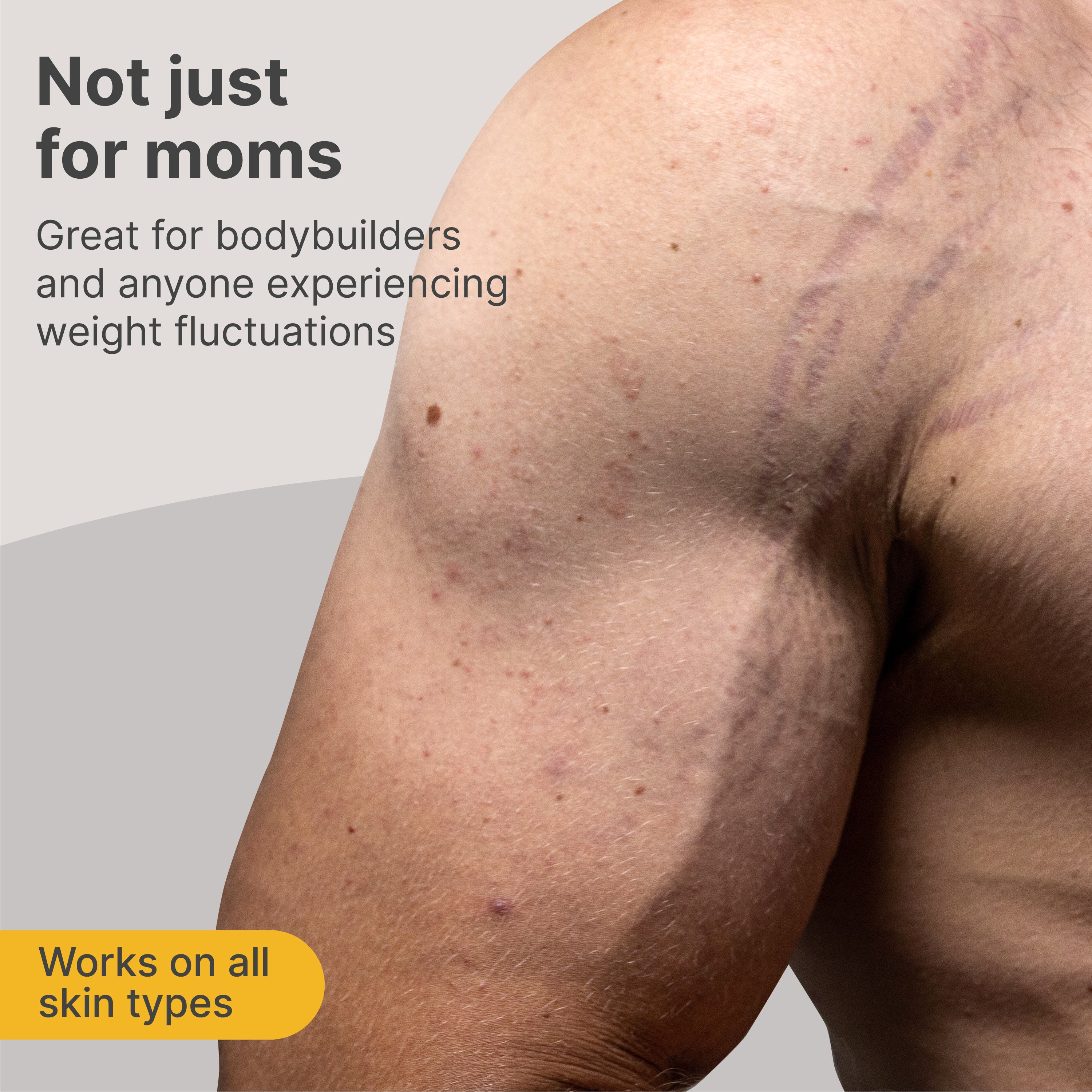 Trilastin Intensive Stretch Mark Cream 3 Month Supply - TriLASTIN