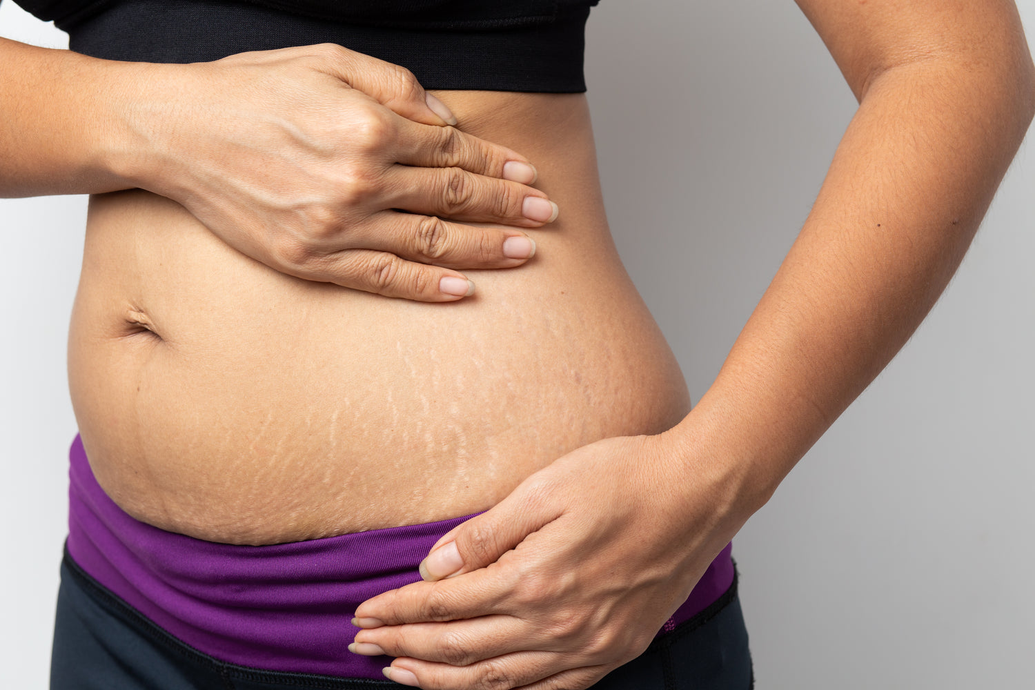 Why Are Stretch Marks More Visible After Losing Weight?