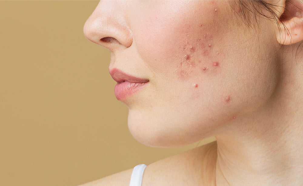 Pregnancy Acne: Tips to Tackle Those Hormonal Breakouts