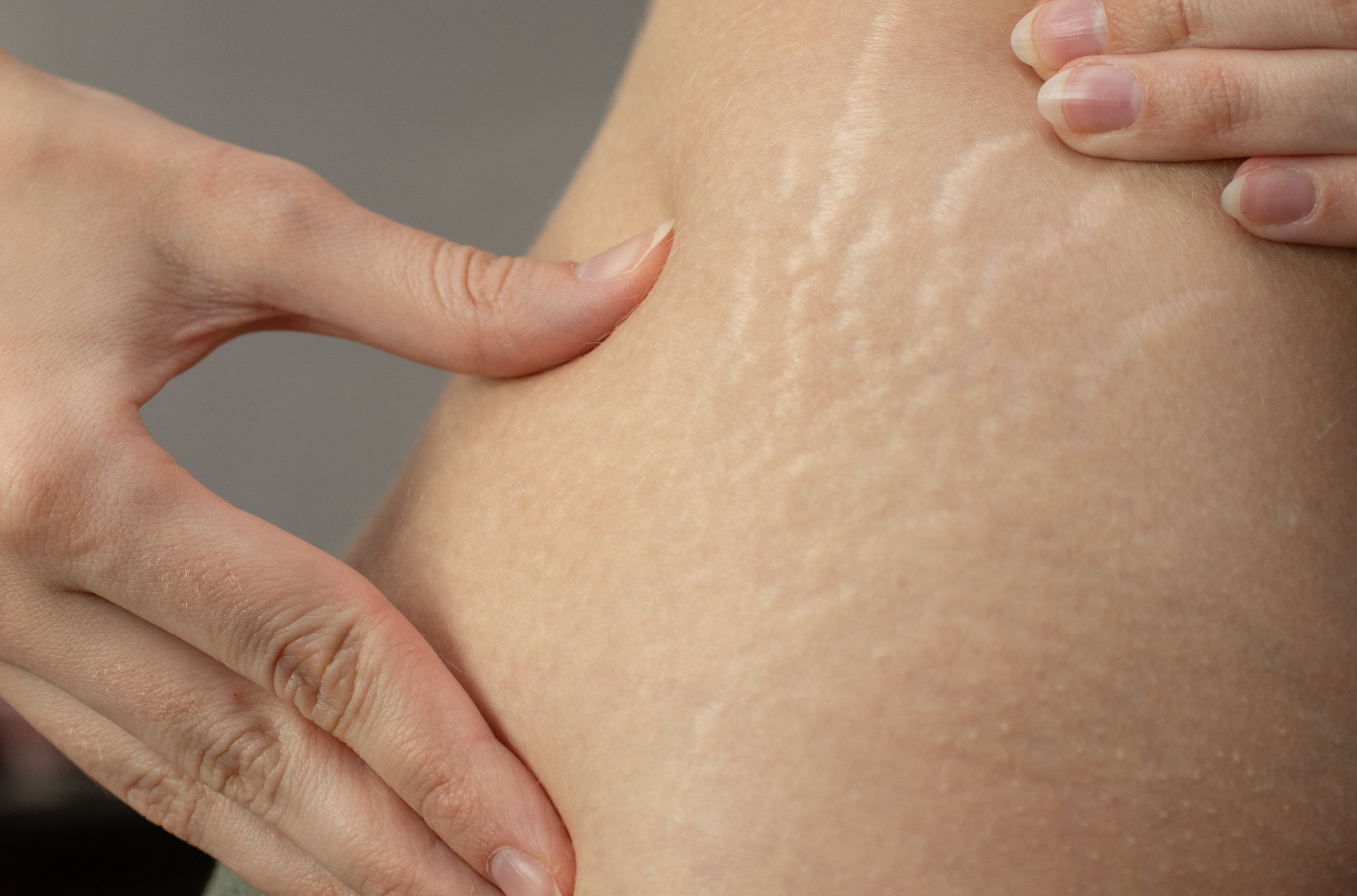 Will it Itch Where Stretch Marks Begin to Form?