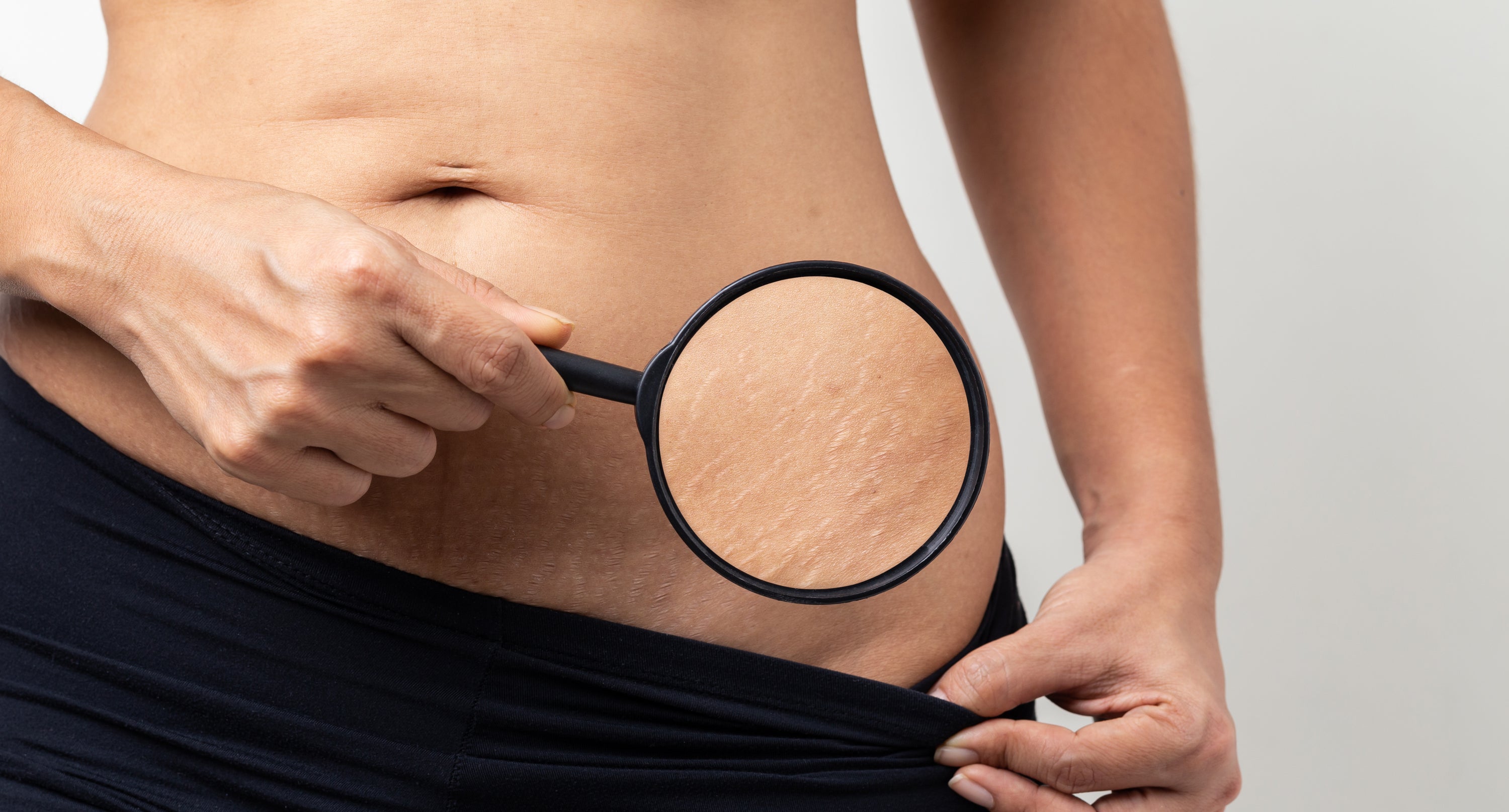 Does Scratching Cause Stretch Marks? – TriLASTIN