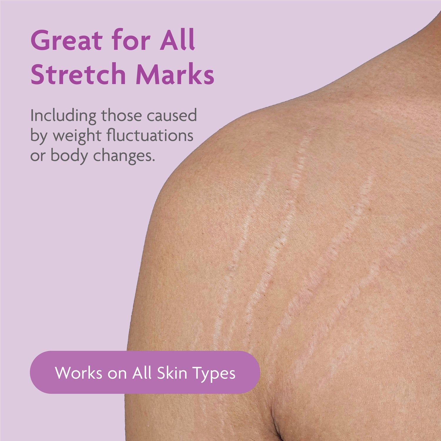 Stretch Mark Treatment Routine