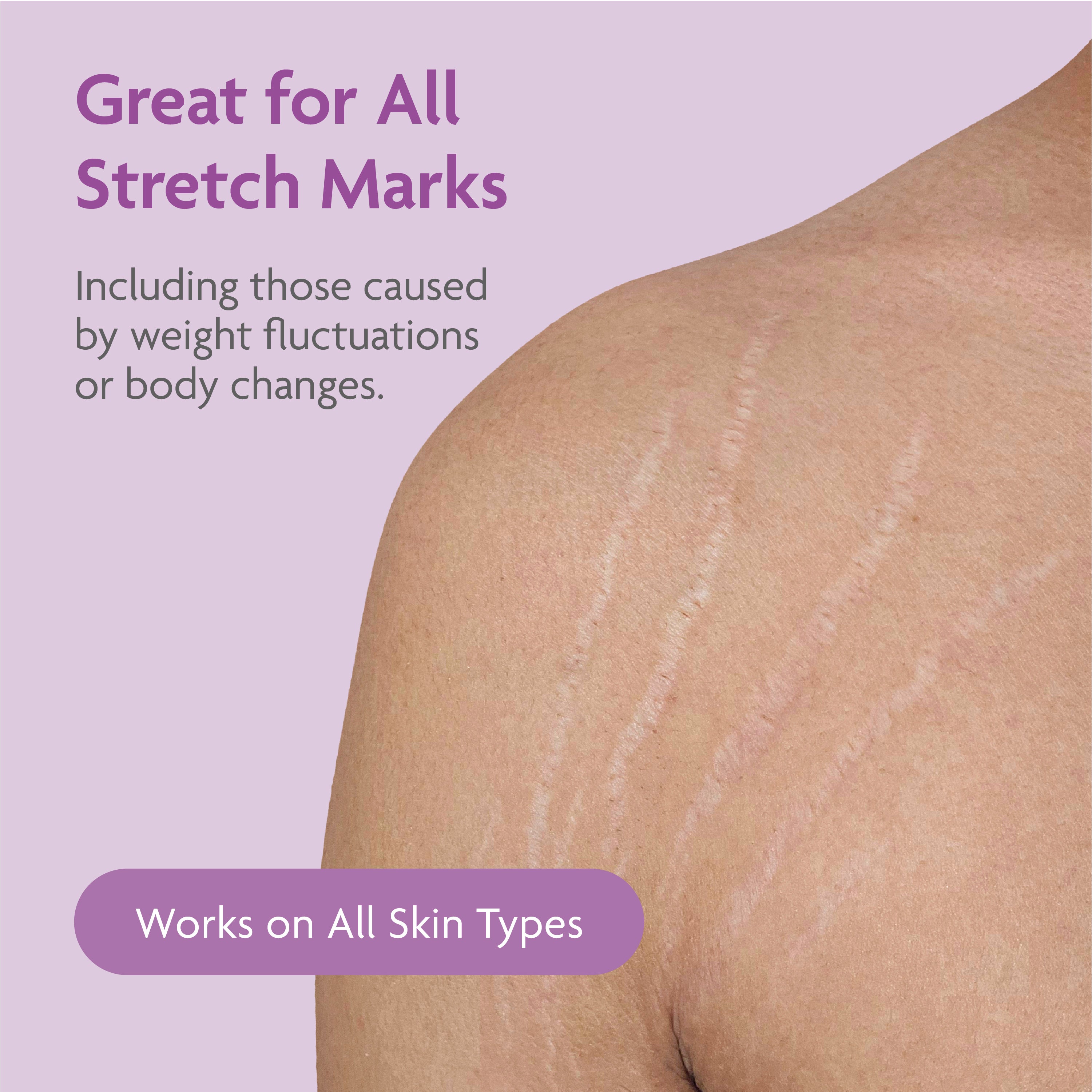 Intensive Firming Stretch Mark Cream